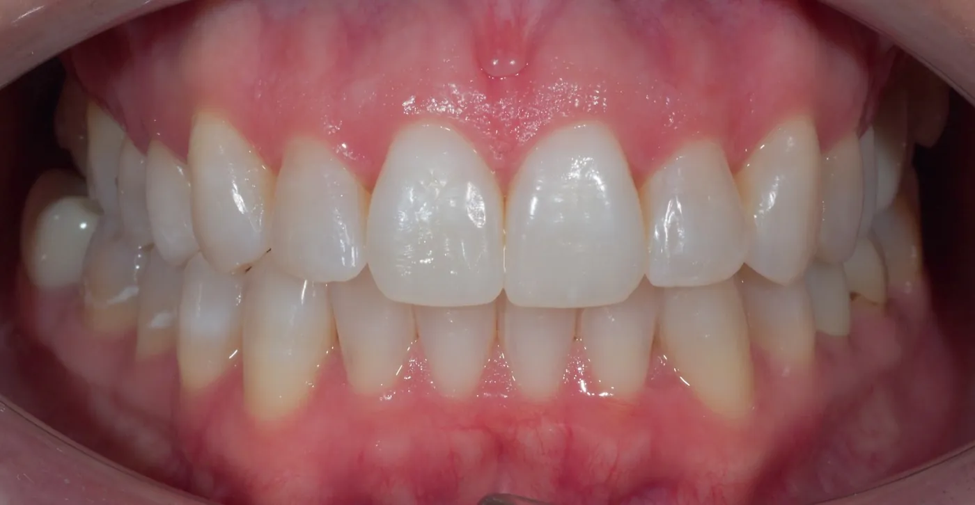 Patient case 1: front teeth after Invisalign treatment