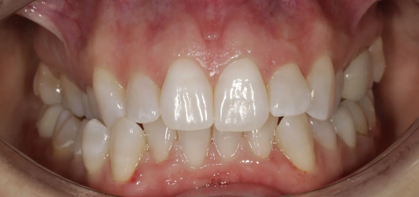 Patient case 1: front teeth before Invisalign treatment